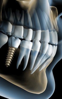 Выгодная имплантация зубов