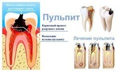  МкДент Лечение пульпита