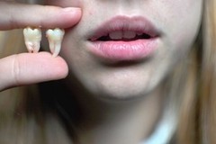  Сабина Удаление зуба